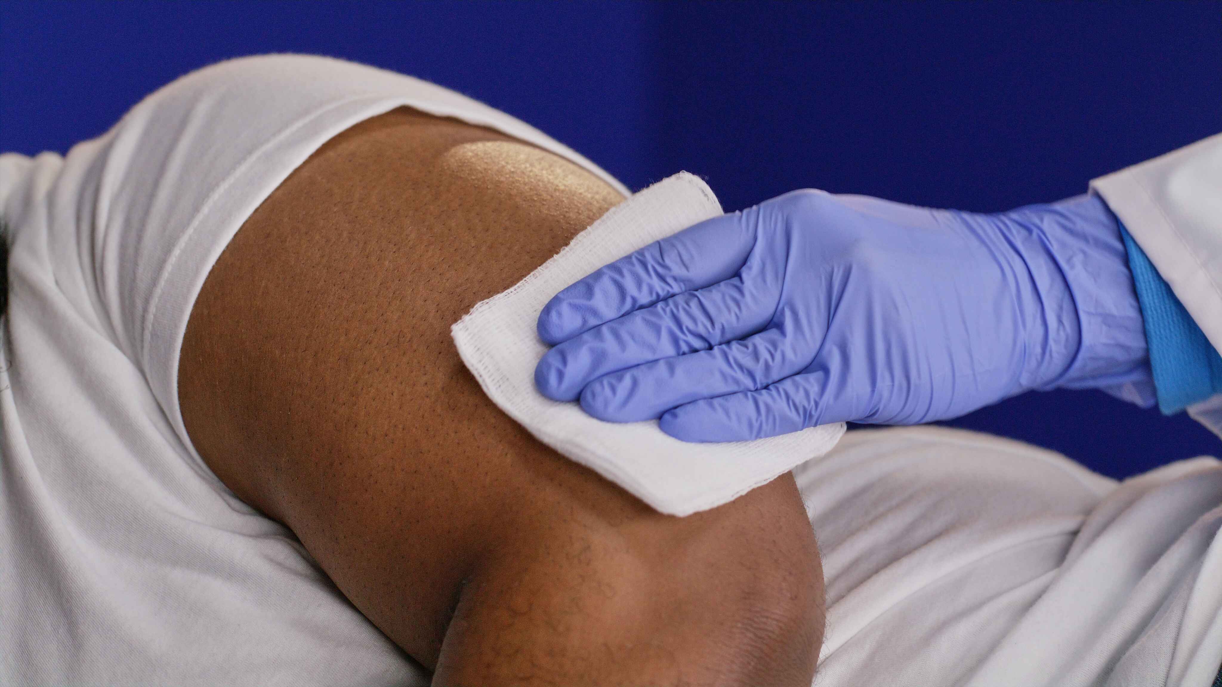 Healthcare provider wearing purple gloves sterilizes and numbs a patient’s upper arm with a gauze pad in preparation for Eversense CGM sensor placement.